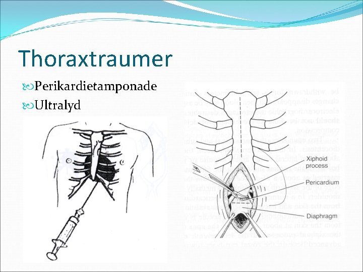 Thoraxtraumer Perikardietamponade Ultralyd 