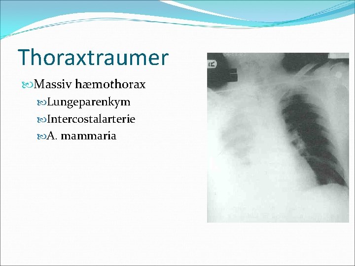 Thoraxtraumer Massiv hæmothorax Lungeparenkym Intercostalarterie A. mammaria 