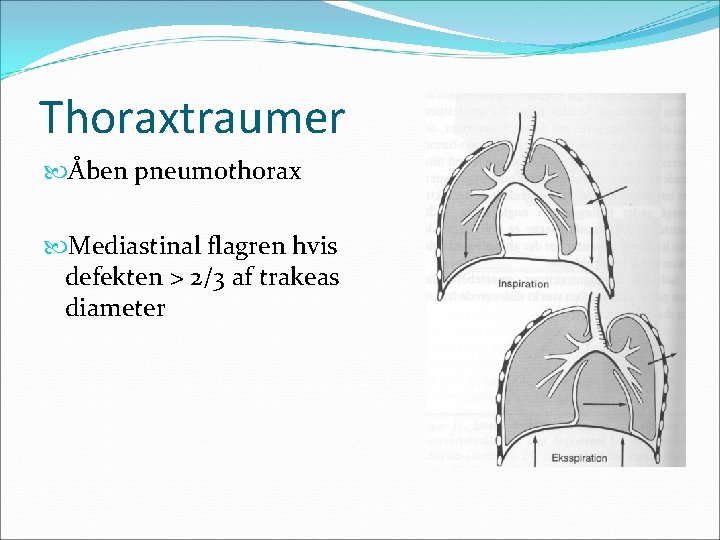 Thoraxtraumer Åben pneumothorax Mediastinal flagren hvis defekten > 2/3 af trakeas diameter 