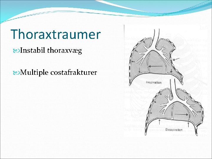 Thoraxtraumer Instabil thoraxvæg Multiple costafrakturer 