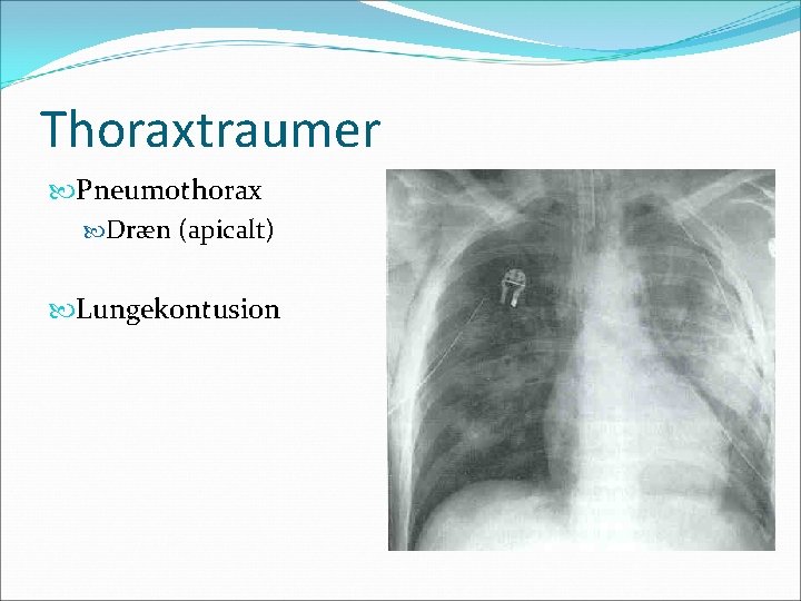 Thoraxtraumer Pneumothorax Dræn (apicalt) Lungekontusion 