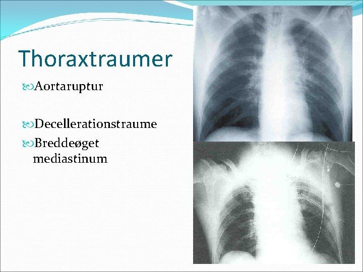 Thoraxtraumer Aortaruptur Decellerationstraume Breddeøget mediastinum 