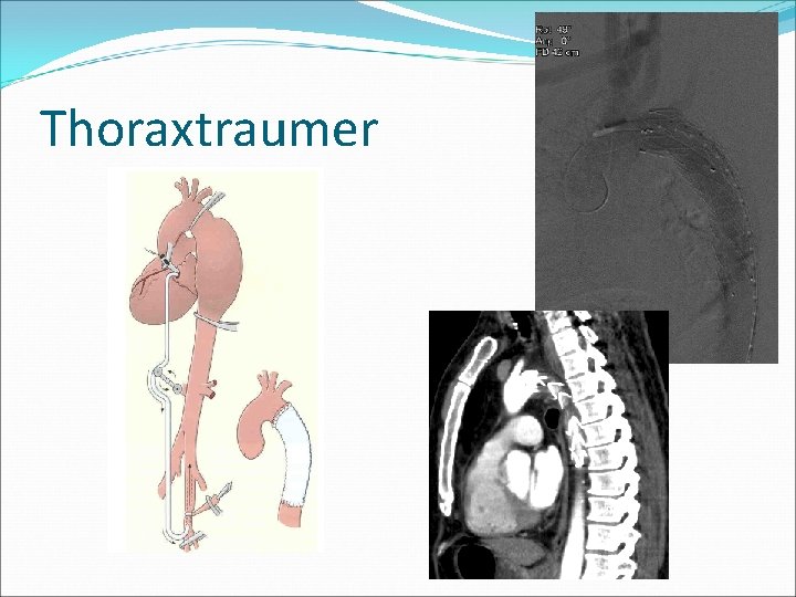 Thoraxtraumer 