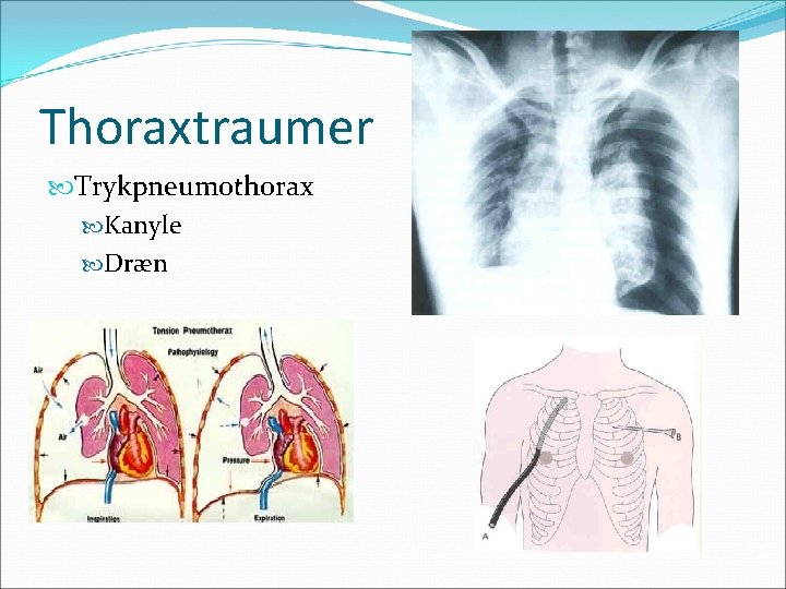 Thoraxtraumer Trykpneumothorax Kanyle Dræn 