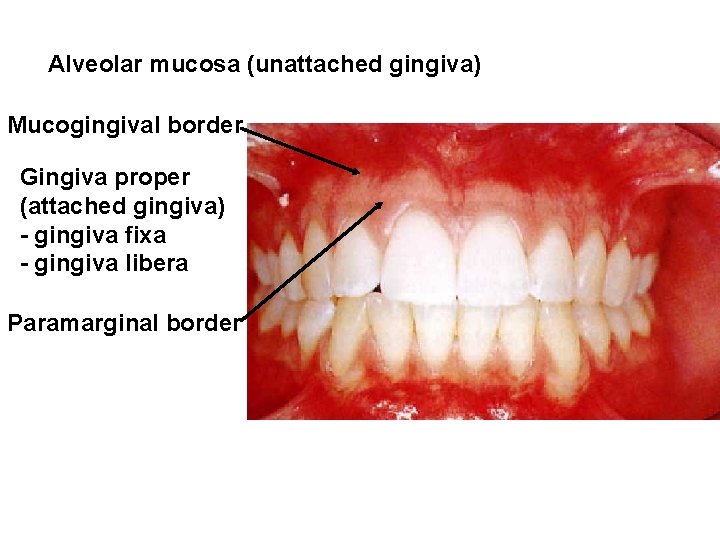 Alveolar mucosa (unattached gingiva) Mucogingival border Gingiva proper (attached gingiva) - gingiva fixa -