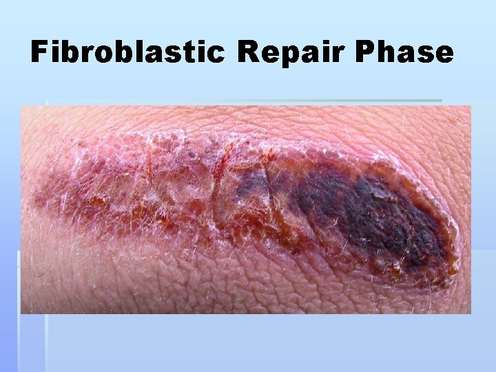 Fibroblastic Repair Phase 