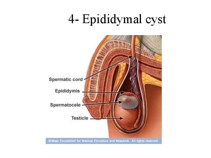 4 - Epididymal cyst 