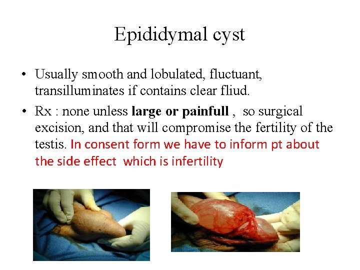 Epididymal cyst • Usually smooth and lobulated, fluctuant, transilluminates if contains clear fliud. •