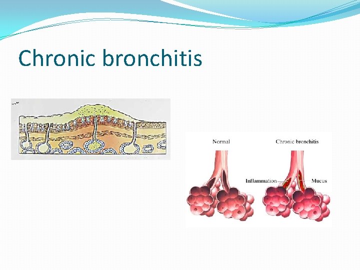 Chronic bronchitis 