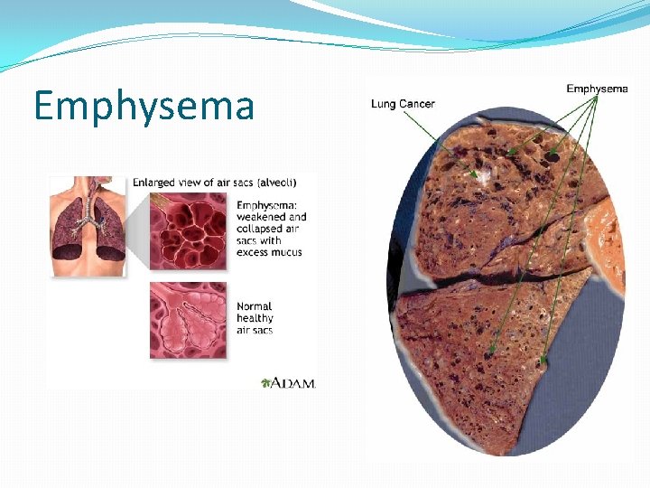 Emphysema 