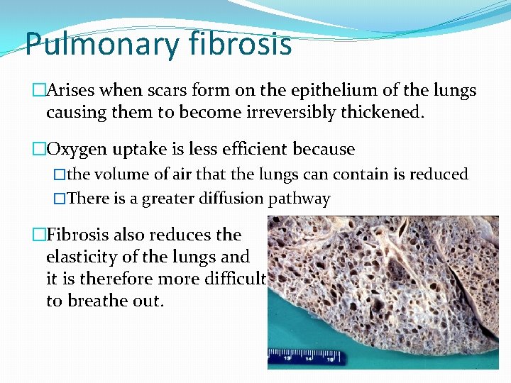 Pulmonary fibrosis �Arises when scars form on the epithelium of the lungs causing them