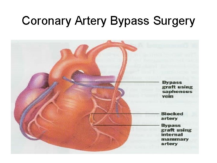 Coronary Artery Bypass Surgery 