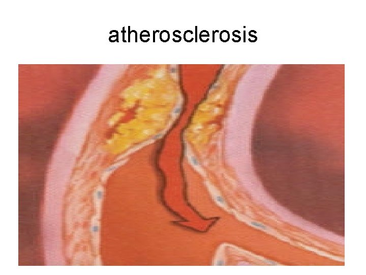 atherosclerosis 