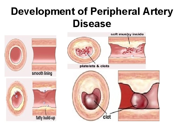 Development of Peripheral Artery Disease 