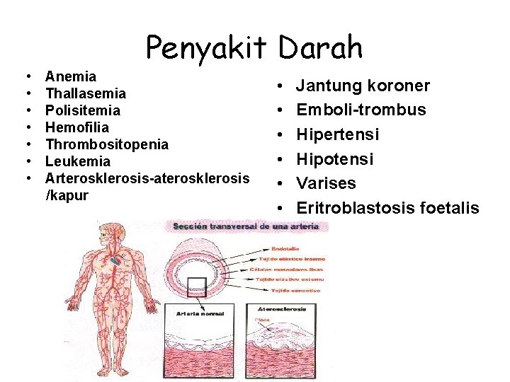 Penyakit Darah • • Anemia Thallasemia Polisitemia Hemofilia Thrombositopenia Leukemia Arterosklerosis-aterosklerosis /kapur • •