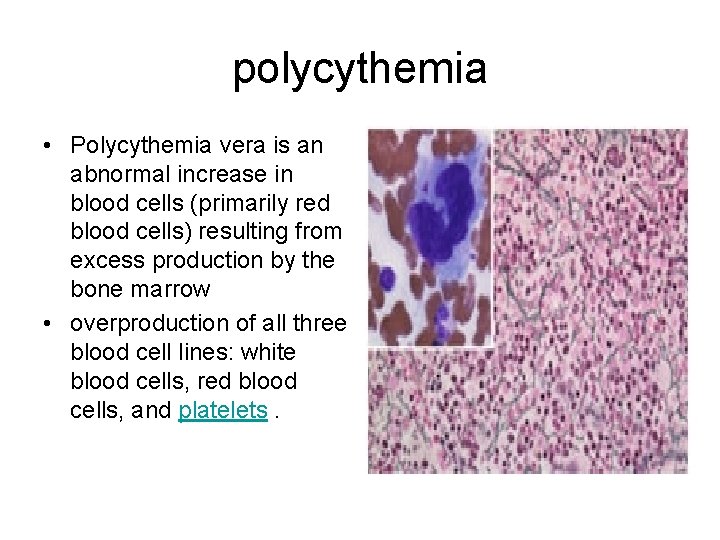 polycythemia • Polycythemia vera is an abnormal increase in blood cells (primarily red blood