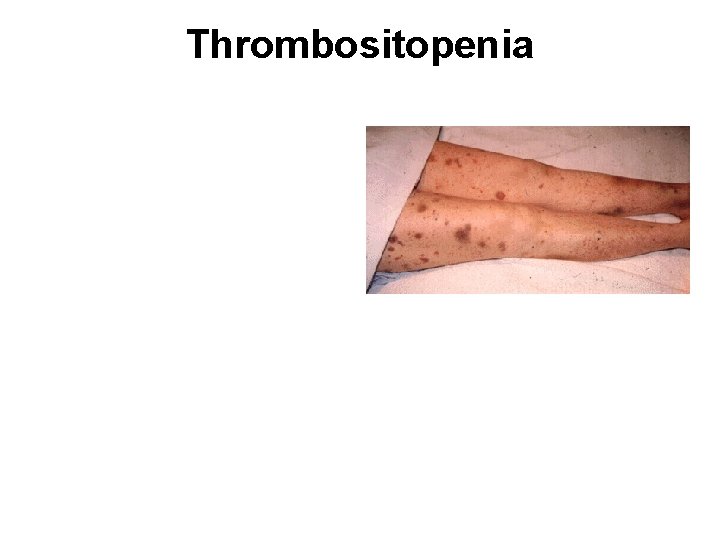 Thrombositopenia 