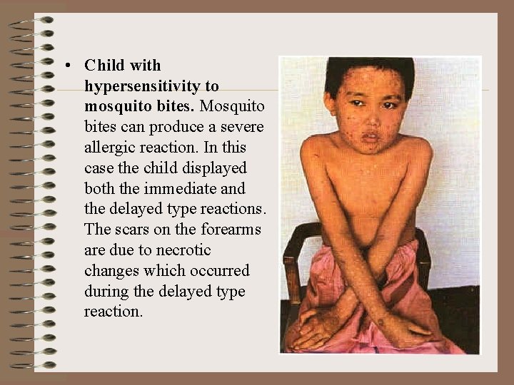  • Child with hypersensitivity to mosquito bites. Mosquito bites can produce a severe