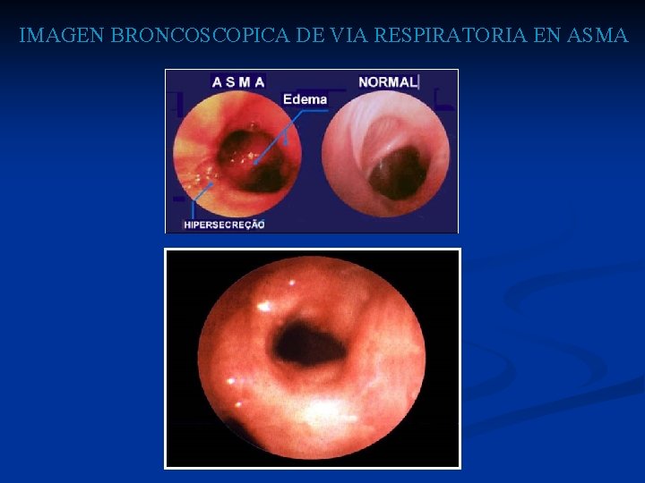 IMAGEN BRONCOSCOPICA DE VIA RESPIRATORIA EN ASMA 