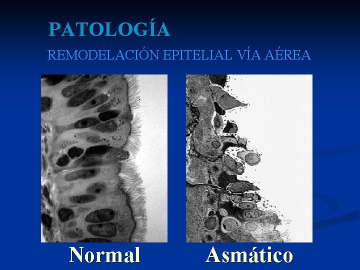 PATOLOGÍA REMODELACIÓN EPITELIAL VÍA AÉREA Normal Asmático 