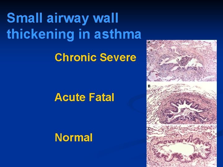 Small airway wall thickening in asthma Chronic Severe Acute Fatal Normal 
