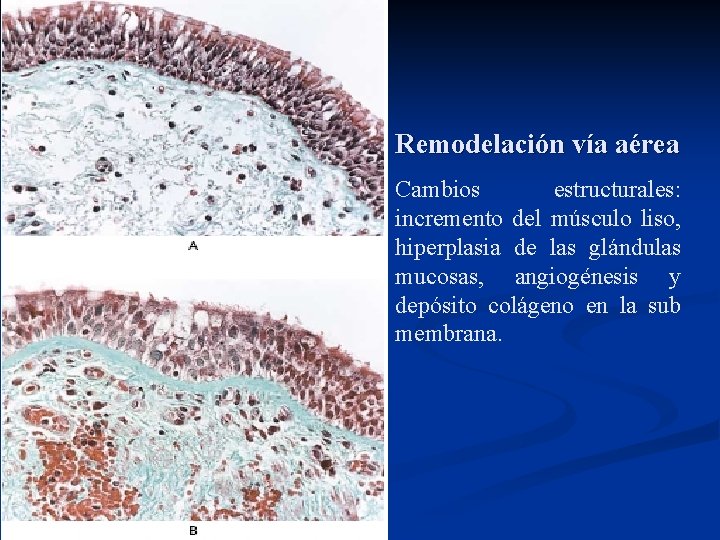 Remodelación vía aérea Cambios estructurales: incremento del músculo liso, hiperplasia de las glándulas mucosas,