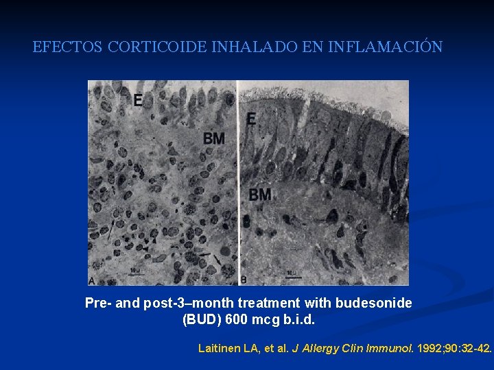 EFECTOS CORTICOIDE INHALADO EN INFLAMACIÓN Pre- and post-3–month treatment with budesonide (BUD) 600 mcg