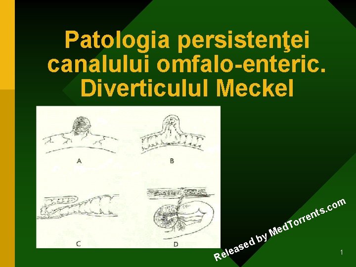 Patologia persistenţei canalului omfalo-enteric. Diverticulul Meckel om c. ts n R e s a Patologia persistenţei canalului omfalo-enteric. Diverticulul Meckel om c. ts n R e s a