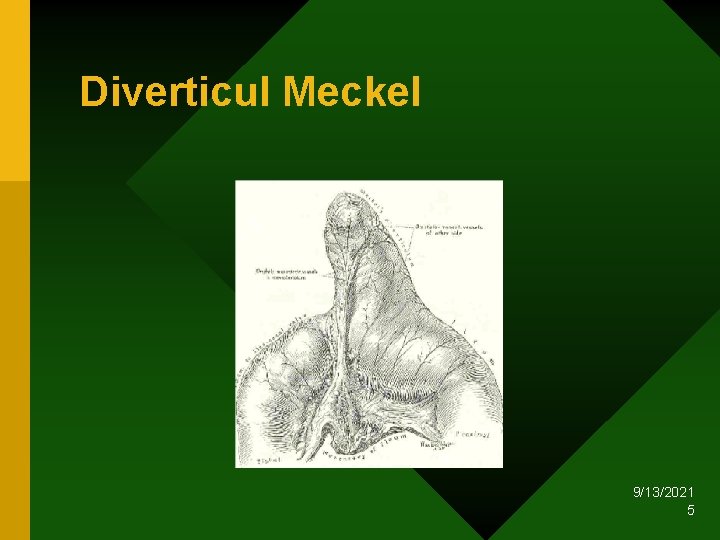 Diverticul Meckel 9/13/2021 5 Diverticul Meckel 9/13/2021 5