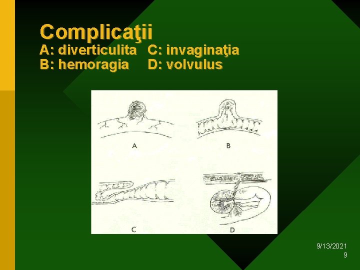 Complicaţii A: diverticulita C: invaginaţia B: hemoragia D: volvulus 9/13/2021 9 Complicaţii A: diverticulita C: invaginaţia B: hemoragia D: volvulus 9/13/2021 9