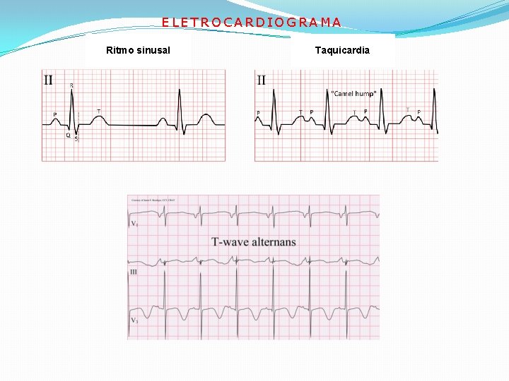 ELETROCARDIOGRAMA Ritmo sinusal Taquicardia 