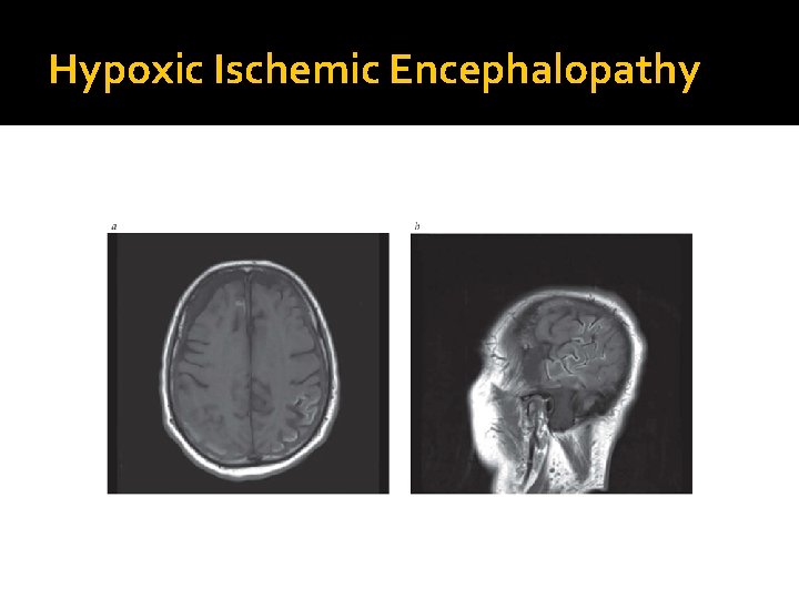 Hypoxic Ischemic Encephalopathy 