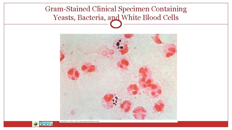 Gram-Stained Clinical Specimen Containing Yeasts, Bacteria, and White Blood Cells 