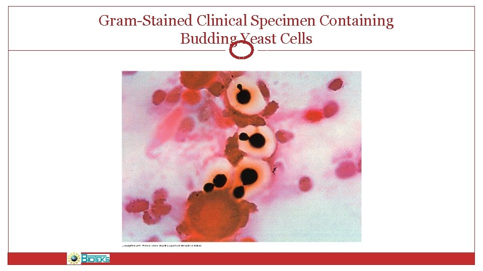 Gram-Stained Clinical Specimen Containing Budding Yeast Cells 