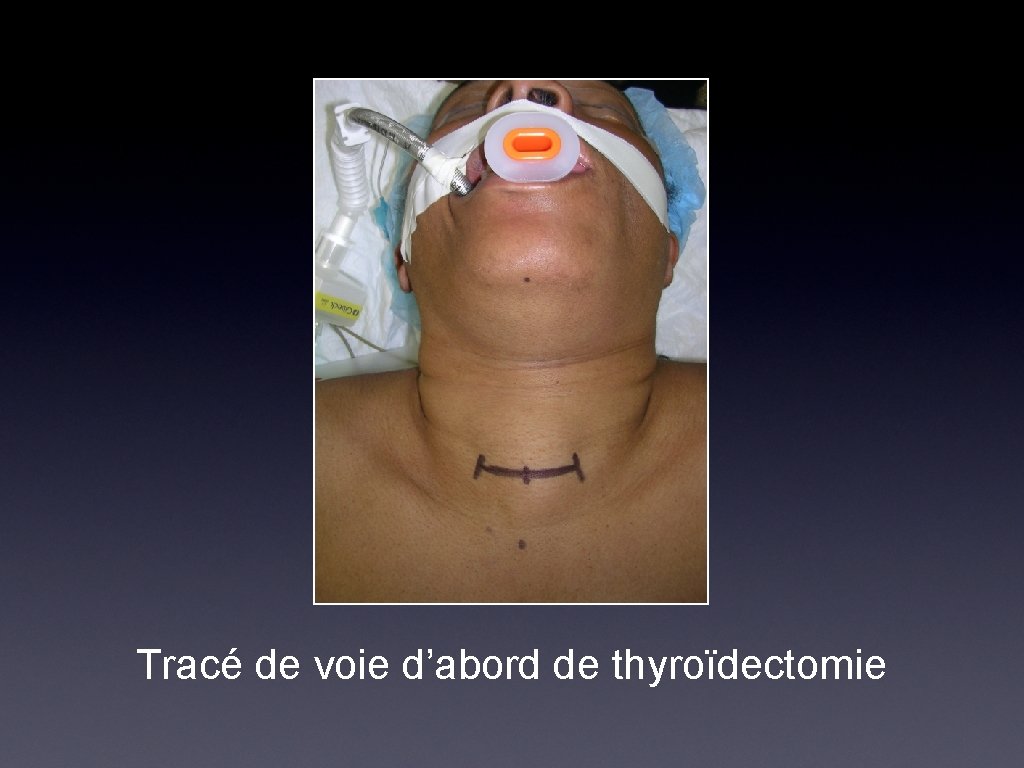 Tracé de voie d’abord de thyroïdectomie 