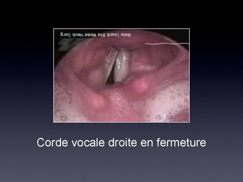 Corde vocale droite en fermeture 