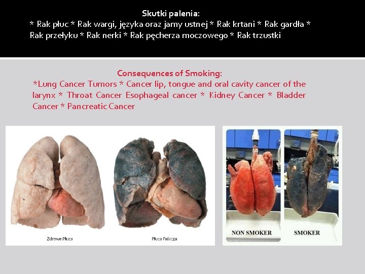 Skutki palenia: * Rak płuc * Rak wargi, języka oraz jamy ustnej * Rak