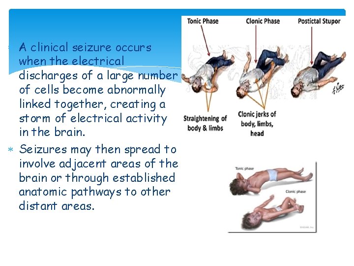  A clinical seizure occurs when the electrical discharges of a large number of