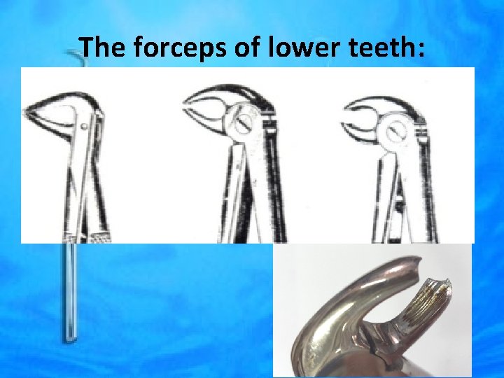 The forceps of lower teeth: 