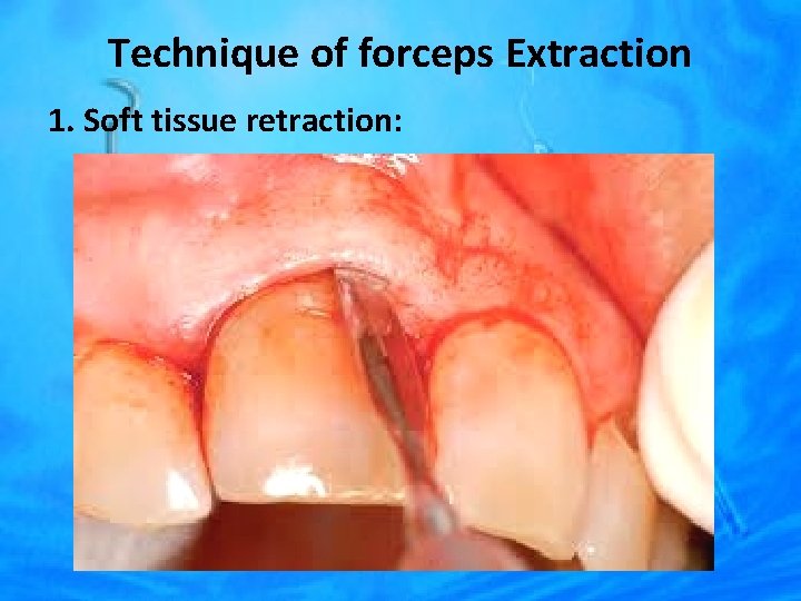 Technique of forceps Extraction 1. Soft tissue retraction: 