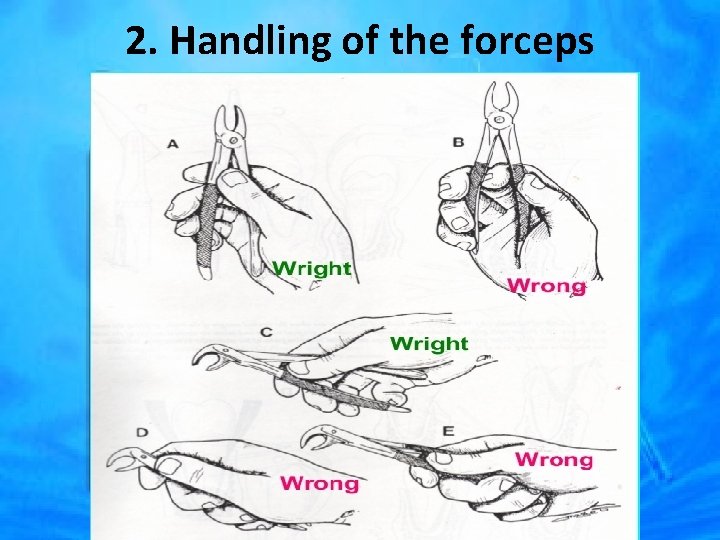 2. Handling of the forceps 