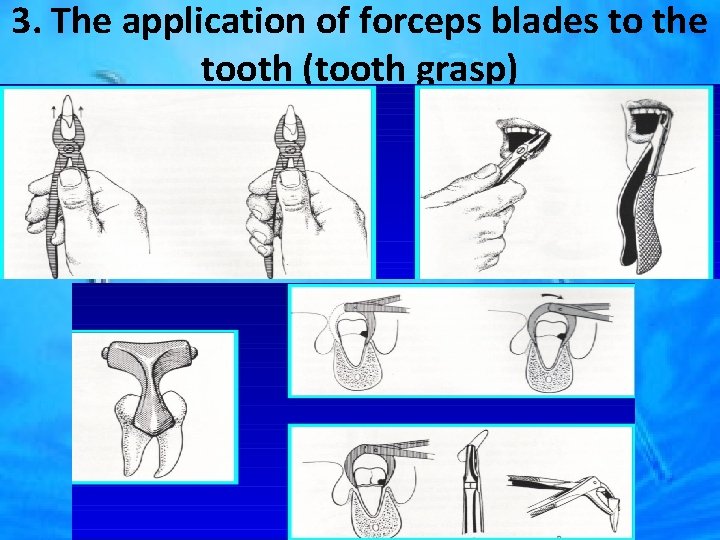 3. The application of forceps blades to the tooth (tooth grasp) 