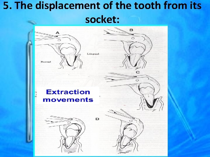 5. The displacement of the tooth from its socket: 