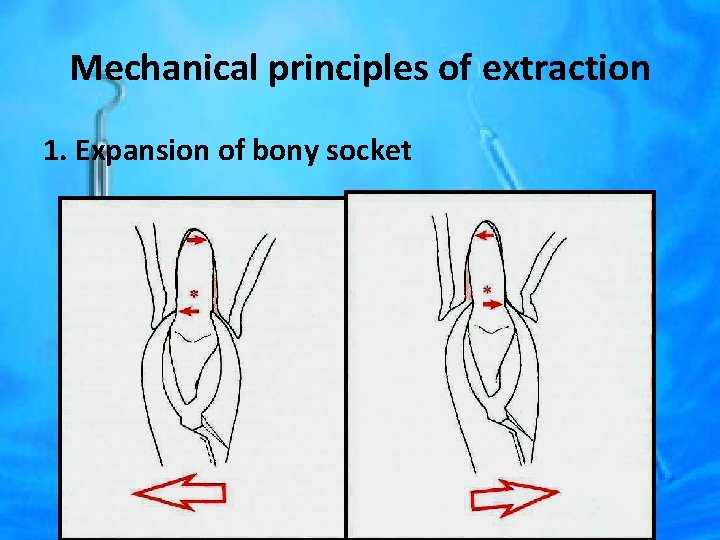 Mechanical principles of extraction 1. Expansion of bony socket 