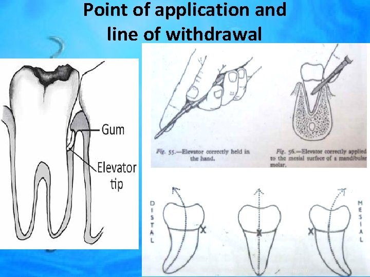 Point of application and line of withdrawal 
