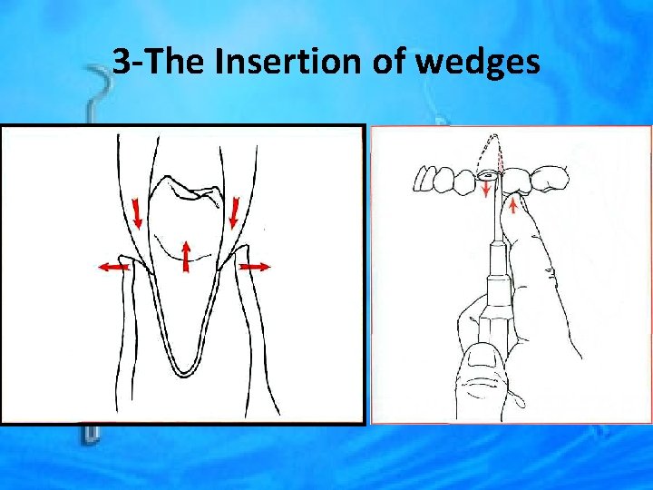 3 -The Insertion of wedges 