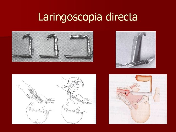 Laringoscopia directa Laringoscopia directa