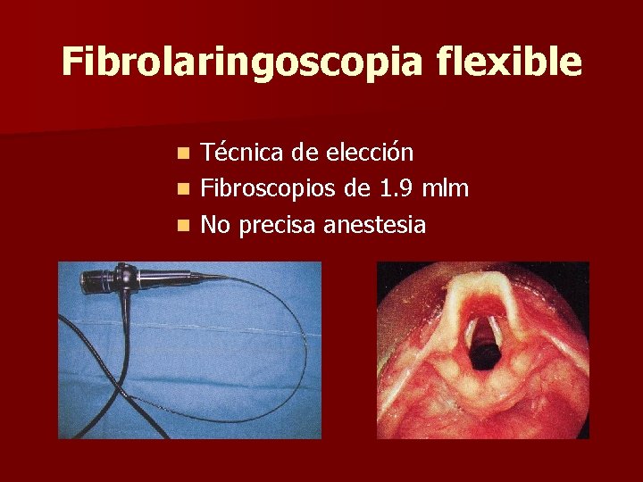 Fibrolaringoscopia flexible Técnica de elección n Fibroscopios de 1. 9 mlm n No precisa Fibrolaringoscopia flexible Técnica de elección n Fibroscopios de 1. 9 mlm n No precisa