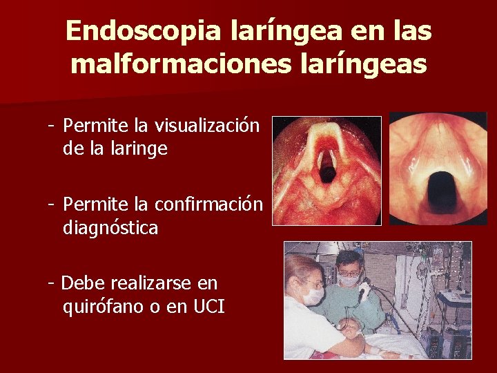 Endoscopia laríngea en las malformaciones laríngeas - Permite la visualización de la laringe - Endoscopia laríngea en las malformaciones laríngeas - Permite la visualización de la laringe -