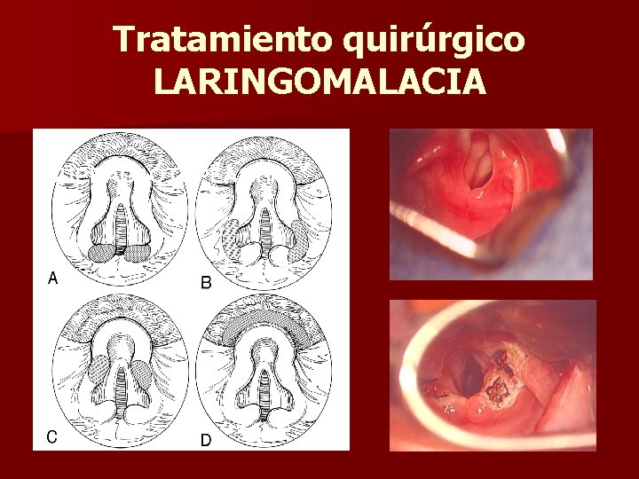 Tratamiento quirúrgico LARINGOMALACIA SUPRAGLOTOPLASTIA Tratamiento quirúrgico LARINGOMALACIA SUPRAGLOTOPLASTIA